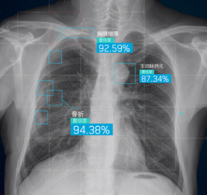 胸部骨折ct圖像輔助分診軟件inferread ct fracture