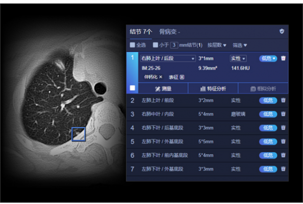 肺結(jié)節(jié)ct圖像輔助檢測軟件ai-rad companion西門子