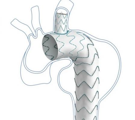 戈?duì)柗种托刂鲃?dòng)脈覆膜血管內(nèi)支架系統(tǒng)gore